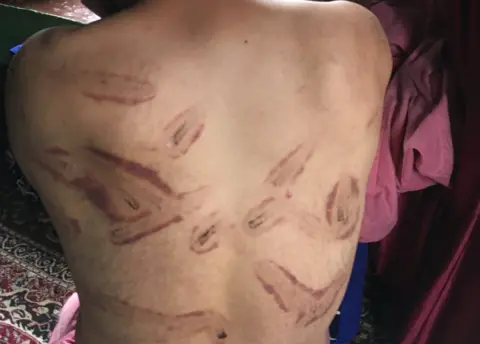 Signs of torture on the back of a man in Kashmir