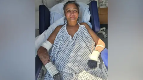 Kam Sangha Manjit in a hospital reclining chair wearing a patterned medical gown, with significant bandaging on her arms and hands. There is medical equipment and a hospital bed behind her. Her fingers are black. 
