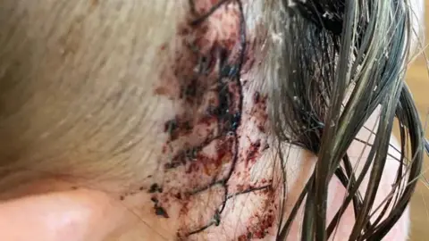 Hayley Burrows / Brain Tumour Research Picture of Hayley's post-surgery scar around her head. The stitches run between her ear and her hairline.