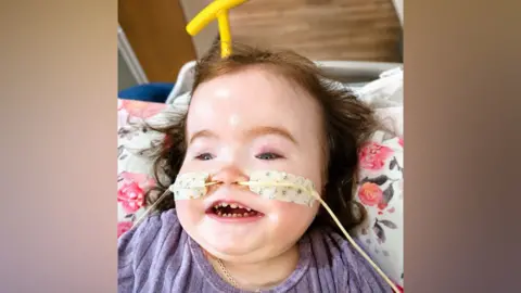 A little girl with dark hair smiles at the camera. She is wearing a purple top and lying on a floral pillow. She has a tube across her face, into each nostril and it is attached to her face with a plaster on either side of nose.