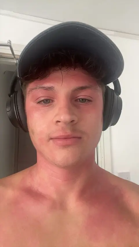 Meilir Rowlands A topless selfie of a young man wearing a black cap and headphones. There are blotchy red patches on his face, neck and chest.