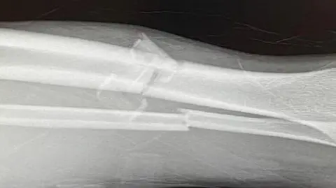 Penistone Church FC An x-ray image of broken bones