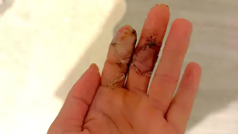 Handout Lily's left hand is pictured close up, with palm facing upward. The tip of the index finger is missing. The rest of the index finger, and the middle finger next to it, have wounds. 