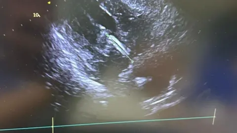 Sheffield Teaching Hospitals NHS Foundation Trust A grainy black and white ultrasound photo shows a thin green stick shape inside shadowy images