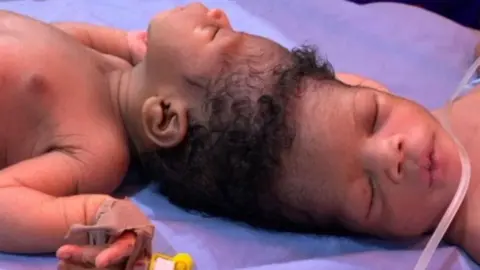 Two babies, joined at the top of their head, lie on a hospital bed