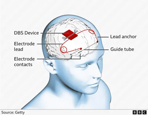 Diagram showing where the device is attached to the skull