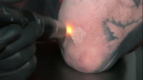 A close-up of a red laser dot directed at a tattoo on a man's arm. It is unclear what the tattoo was of, but you can see an area of black ink. Where the laser has already been directed, the skin is slightly raised and white.