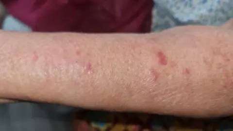 The forearm of a woman showing a number of red blotches from insect bites