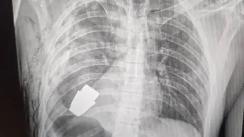 Facebook/Ukraine medical force command An X-ray shows the grenade close to the soldier's heart