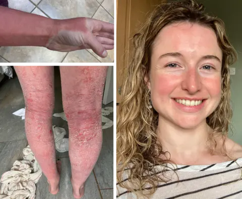 Jenna Crosbie On the left are two images of Jenna Crosbie's legs and arms which are severely red, blistering and her skin is flaking off. On the right her skin looks healthier and she is smiling