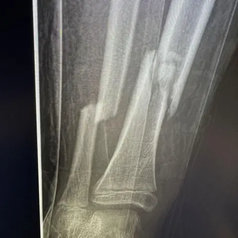 Supplied An x-ray image showing two broken bones