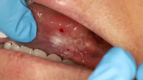 Margot's mouth is open with gloved fingers and a white lesion with two blood spots can be seen on her tongue