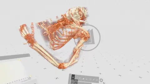 scan view of the patient's broken arm