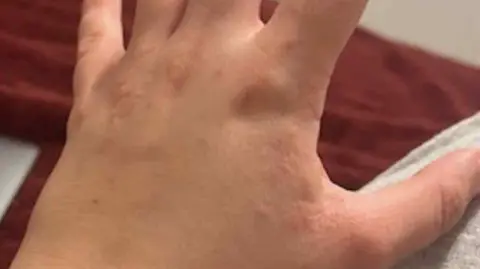 Sasha McCabe A hand with clear signs of irritation at the base of the fingers. There are red lumps with the skin looking particularly dry in areas.