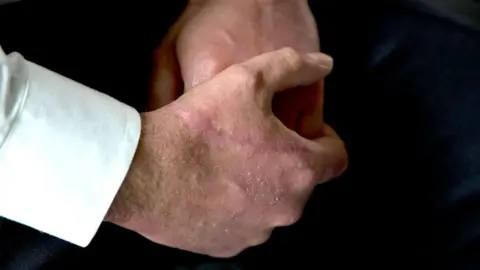 Slash wound on the hand of Inspector Moloy Campbell. Stitch marks can be seen on the top of his hand below the thumb when the injury was sustained