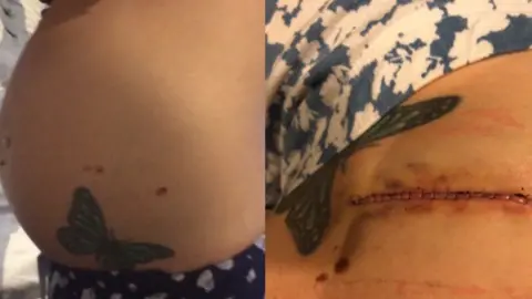 Emma Giannuzzi A composite image. On the left, there is a picture of Emma's bump with a butterfly tattoo and the mole. On the right, is an image of her scar after having the mole removed.