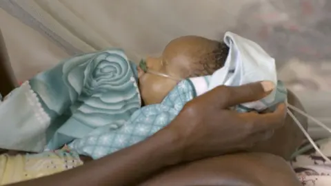 Baby with joined mouth and nose, lying wrapped in a cloth, hospital in Bentiu