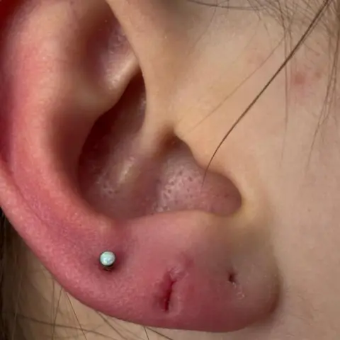 Lucy Quinn A close up imagine of a swollen infected ear piercing. There are three piercings on the lobe of the ear, with one stud earing in the third piercing. 