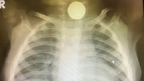 Calham Hill X-ray showing battery in throat