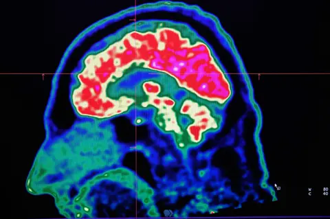 AFP Molecular image of a human brain, seen through a positron emission tomography (PET) scanner at University Hospital Center of Brest, in France