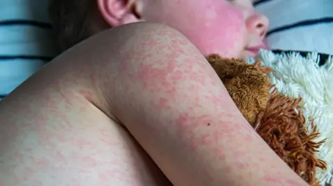 A young boy lying down, covered in a red rash, hugging a soft toy