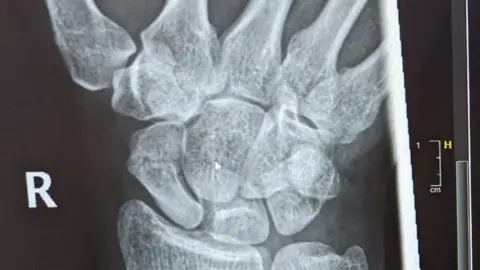 Louise Ketteringham X-ray of Louise Ketteringham's hand