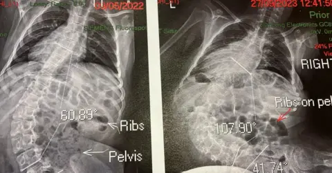 Jill Lockhart X-rays of Eva's spine show the curvature has worsened without the operation