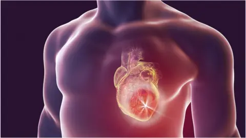 Science Photo Library Heart attack illustration