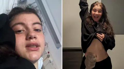 BBC Sophia before and after Stoma