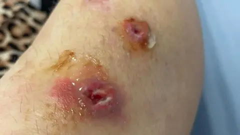 PA Media A close up image of Davies' injuries shows two puncture wounds in her leg. The skin around both is very red and at least one appears infected.