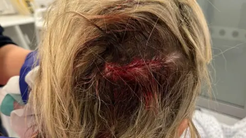 Megan Lynch A close up showing the back of a woman's head where a large laceration, which has been recently stitched, is visible on her scalp. Her blonde hair is still matted with blood. 