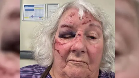 Christine Reid's face framed with grey hair, showing injuries from falling over on the uneven pavements. She has cuts to her forehead, nose and cheek with a bruise over her right eye.