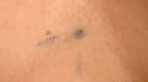 Cancer Research UK A section of skin showing three small dark blue tattoo marks to allow accurate delivery of radiotherapy.