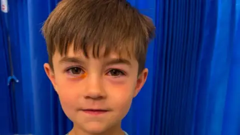 Hudson, a young boy seen with major irritation around his eyes. His left eye has a swollen and bruised colour to it underneath the retina. His right eye has an orange tint underneath.