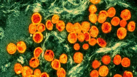 Getty Images 显微镜下的 Mpox 病毒颗粒