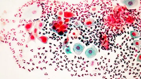 SCIENCE PHOTO LIBRARY Microscope image of cells, showing some abnormal cells 