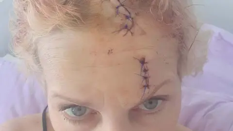 Family A close up of a woman's injured head with multiple stitches. Her blonde hair is bloodied as she looks up at the camera.