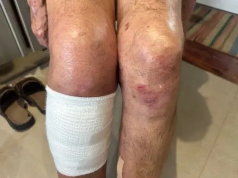 Rolf Kern's injured legs, with one bandaged