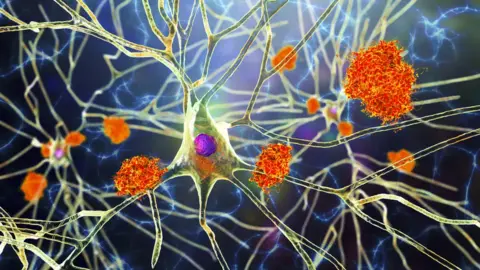 Getty Images Brains with Alzheimer's are known to feature proteins called amyloid and tau