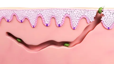 Getty Images A computer generated image shows how scabies mites burrow into the human skin