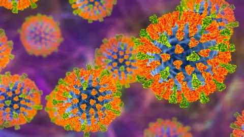 Getty Images Measles