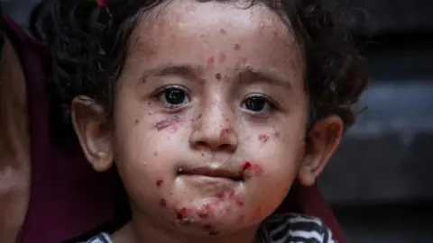 Reuters Yasmine al-Shanbari, msichana wa Kipalestina aliye na maambukizi ya ngozi, ameketi na baba yake huko Jabalia kaskazini mwa Ukanda wa Gaza (5 Agosti 2024)