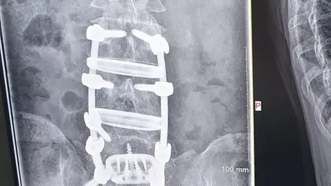 Glenn Meyer An x-ray image of a cage around a spine.