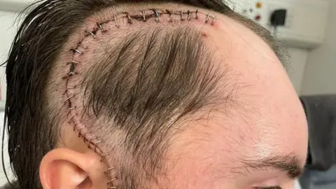 SEAN SWEENEY A close-up of the scar left by brain tumour surgery