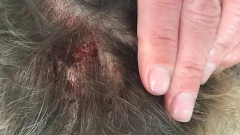 Kelda Griffiths bite mark on head