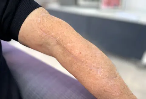 Huge shark bite mark on Peter's arm 