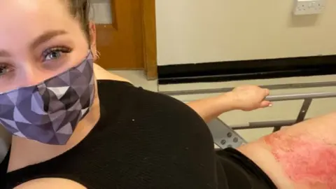 Cara Wilson Cara Wilson suffered burns to her leg