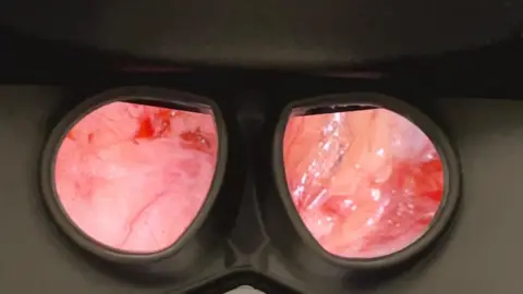 A photo of taken through the viewfinder of the robot console. Through the googles you can see the red blood cells and flesh inside the abdomen of the patient