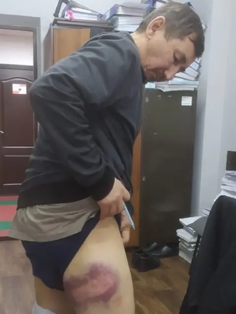 Galym Nurpeisov Muratbek Yesengazy shows his leg covered in bruises