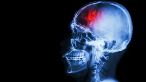 stockdevil/Getty Images Stroke in the brain